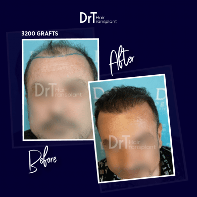 Request a Free Consultation - DrT Hair Best Hair Transplant Clinic