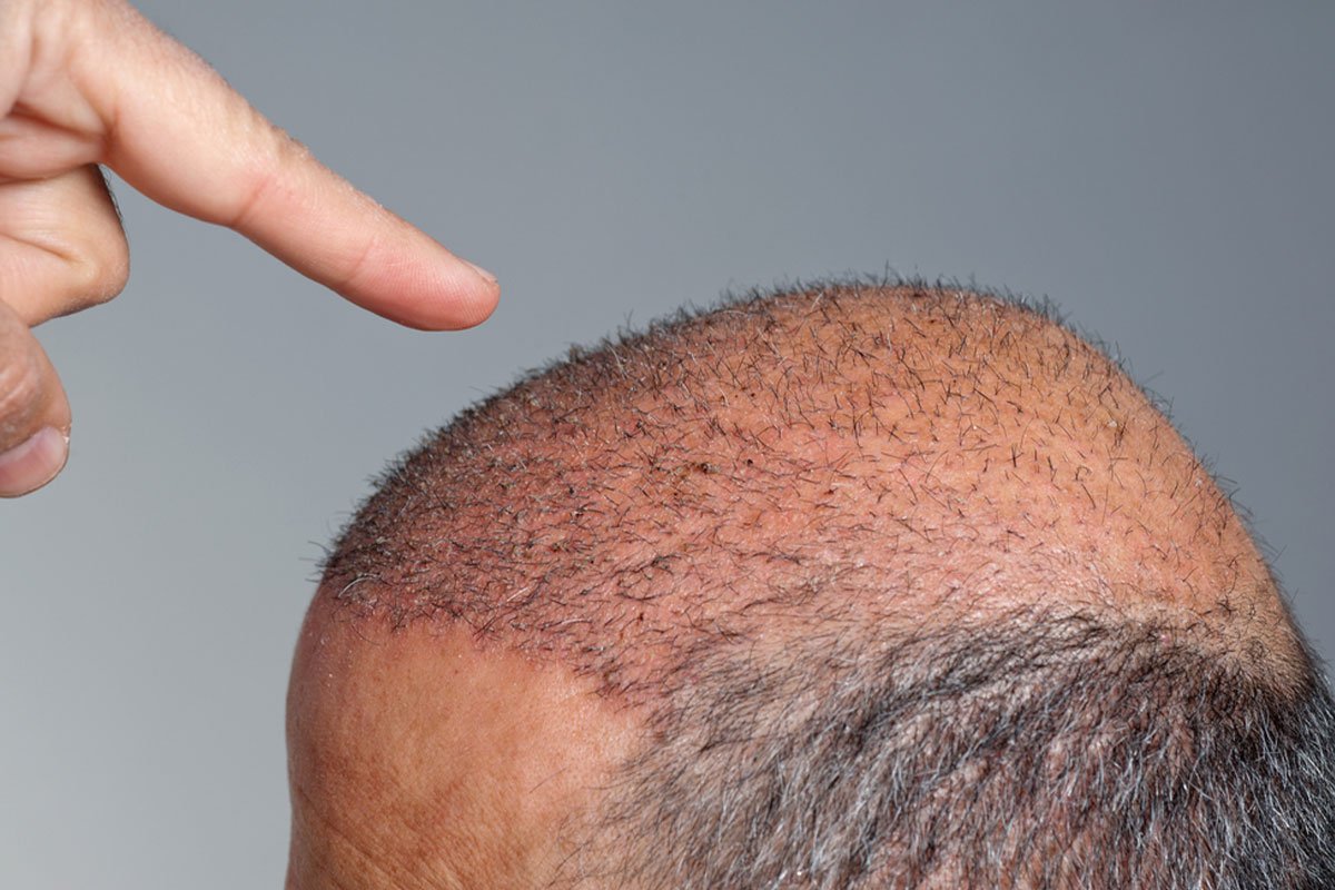 Post-operation Care (Aftercare) for a Hair Transplant: Is it hard or painful?  - DrT Hair Best Hair Transplant Clinic