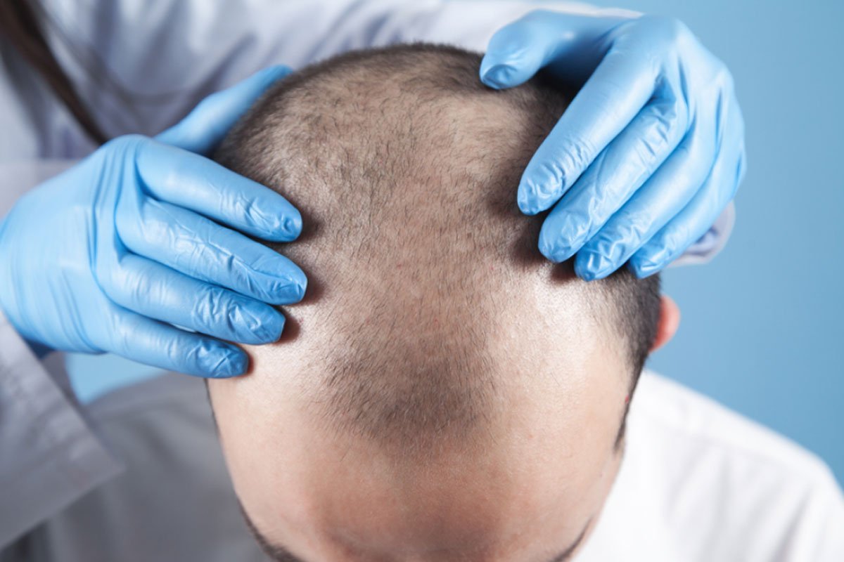 Is a FUE Hair Transplant Painful? - DrT Hair Best Hair Transplant Clinic