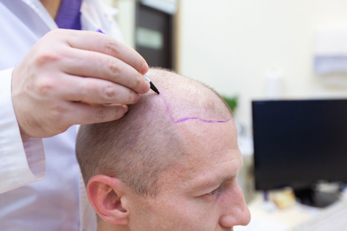 Can a Hair Transplant go wrong? - DrT Hair Best Hair Transplant Clinic