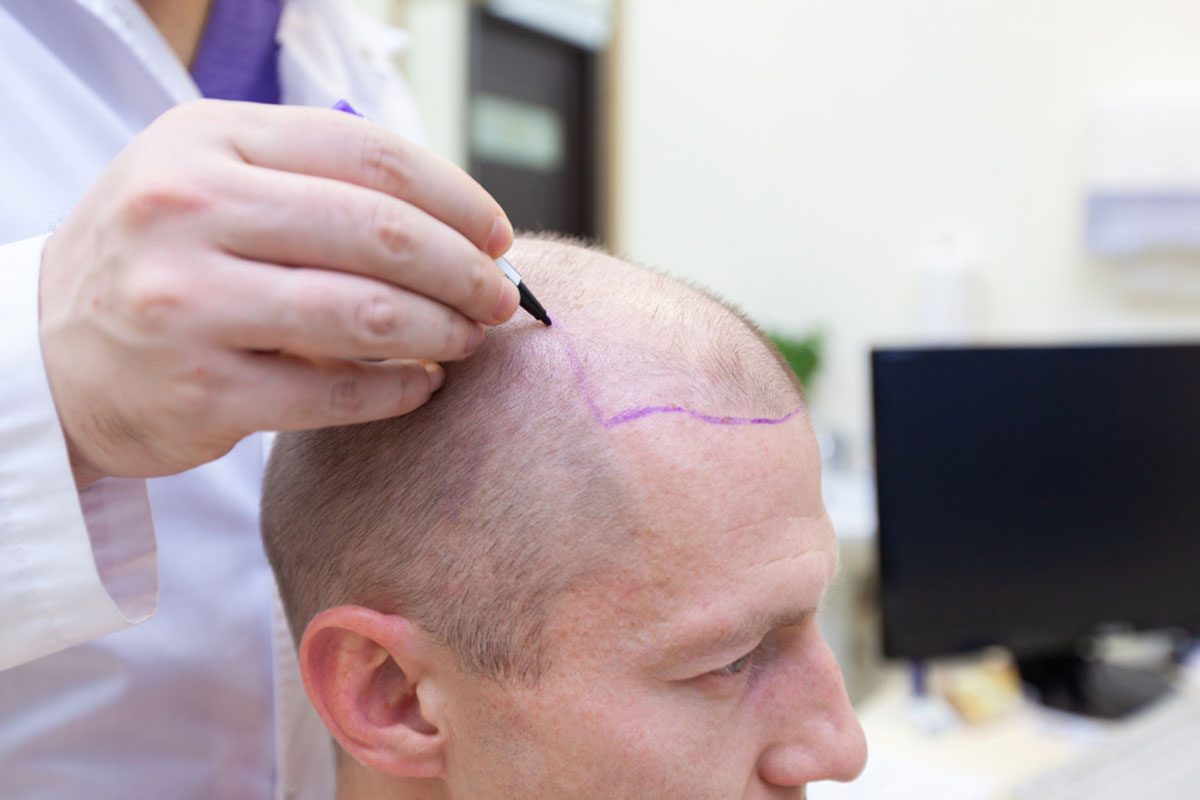 Failed Hair Transplant Repair  Medispa India